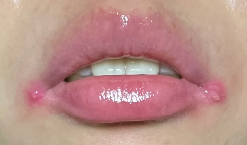 经常烂嘴角是缺乏什么维生素引起的