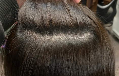 头皮上摸到微微鼓起的包块是怎么了 头皮上摸到微微鼓起的小包会自己好吗 头皮上摸到微微鼓起的包块是怎么了 头皮上摸到微微鼓起的小包会自己好吗