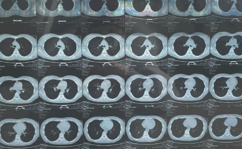 什么情况需要做肺部CT 做肺部ct要多少钱一次