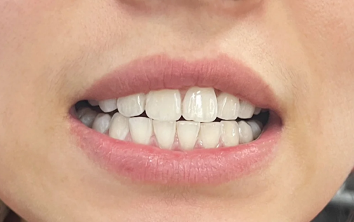 全口牙周刮治多少钱一次2023(牙周刮治可以一次性全口刮治吗) 全口牙周刮治多少钱一次2023(牙周刮治可以一次性全口刮治吗)