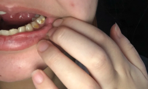 每个洗牙的医生都说有牙周炎是真的吗（牙周炎一辈子就完蛋了吗）