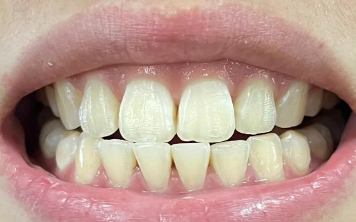 龈下刮治一周后红肿更严重了怎么办(龈下刮治害死人什么说法) 龈下刮治一周后红肿更严重了怎么办(龈下刮治害死人什么说法)