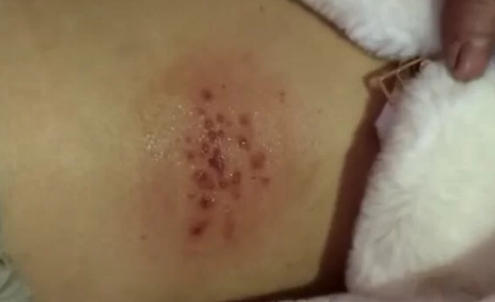 疱疹病毒一旦感染终身携带吗(疱疹病毒感染了以后一辈子都好不了吗) 疱疹病毒一旦感染终身携带吗(疱疹病毒感染了以后一辈子都好不了吗)