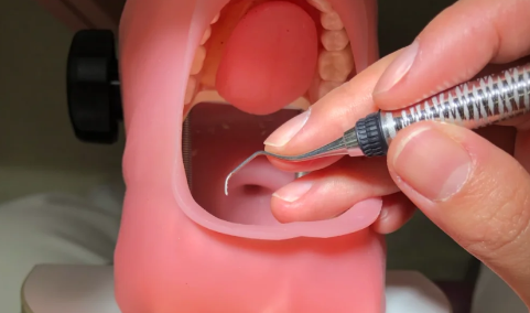 龈下刮治是不是每年要做1