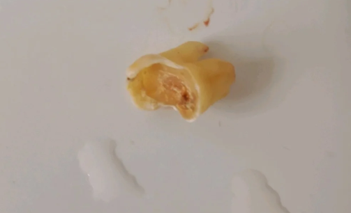 拔智齿食物残渣会长到肉里吗