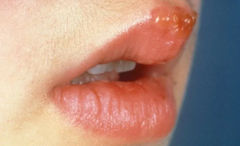 疱疹病毒一旦感染终身携带吗(疱疹病毒感染了以后一辈子都好不了吗) 疱疹病毒一旦感染终身携带吗(疱疹病毒感染了以后一辈子都好不了吗)