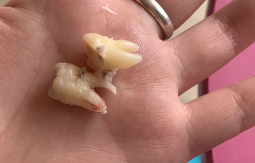 拔智齿食物残渣会长到肉里吗