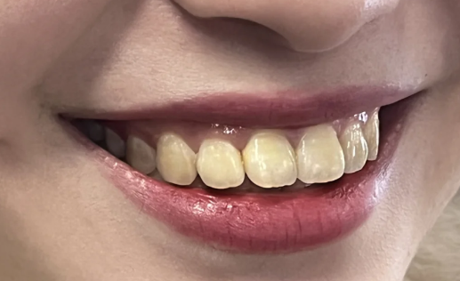 每个洗牙的医生都说有牙周炎是真的吗（牙周炎一辈子就完蛋了吗）