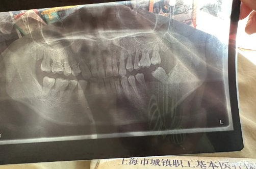 全口牙周刮治多少钱一次2023(牙周刮治可以一次性全口刮治吗) 全口牙周刮治多少钱一次2023(牙周刮治可以一次性全口刮治吗)