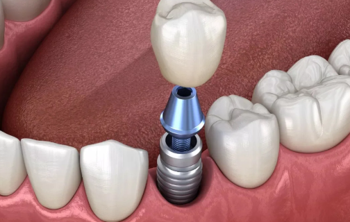 种植牙多少钱一颗2023价格表(2023年种植牙可以纳入医保吗) 种植牙多少钱一颗2023价格表(2023年种植牙可以纳入医保吗)