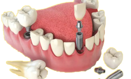 种植牙多少钱一颗2023价格表(2023年种植牙可以纳入医保吗) 种植牙多少钱一颗2023价格表(2023年种植牙可以纳入医保吗)
