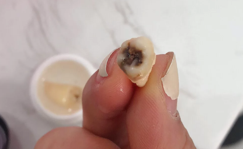 拔智齿后嘴巴越来越臭怎么回事