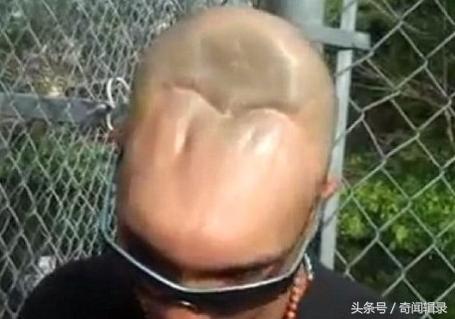 美国半脑哥活了多久（医学奇迹半脑哥智商正常吗）