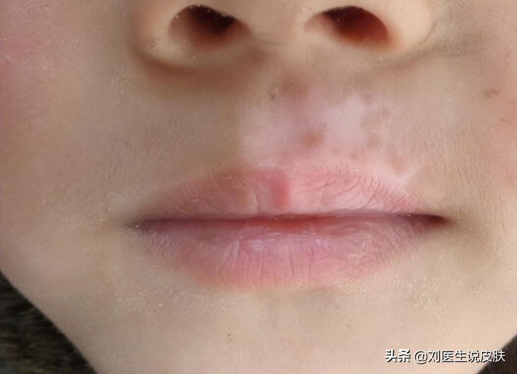 冯小刚白斑治好了吗（冯小刚白斑自愈心得）