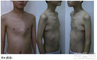 鸡胸是什么样的图片（鸡胸和正常人区别）