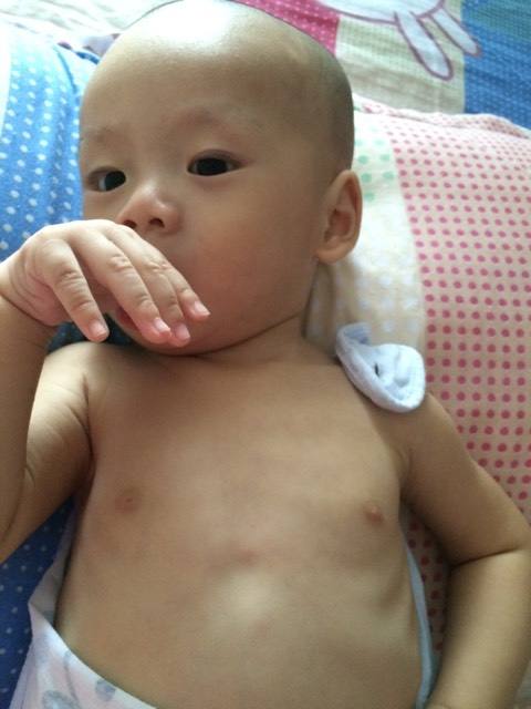 鸡胸是什么样的图片（鸡胸和正常人区别）