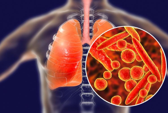 支原体肺炎会引起肺纤维化吗（支原体肺炎会引起肺空洞吗）