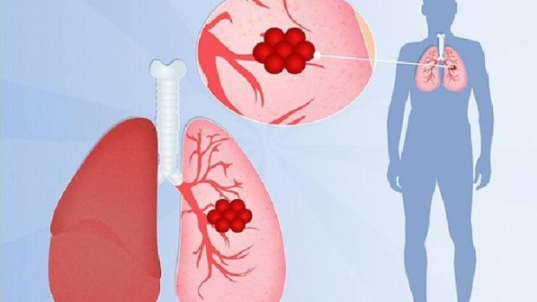支原体肺炎和新冠哪个传染性强(支原体肺炎比新冠肺炎传染性强吗) 支原体肺炎和新冠哪个传染性强(支原体肺炎比新冠肺炎传染性强吗)